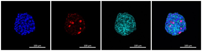 Fluoreszenzaufnahme eines Organoids des Ovarialkarzinoms. Verschiedene Kompartimente wurden gefärbt; Zellkerne in Blau, sich teilende Zellen in Rot, Zellskelett in Cyan, und die kombinierte Aufnahme sind dargestellt.